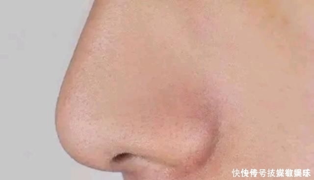 鼻子里面挤出来“白色小芝麻”，越挤越畅快？劝你别乱挤了