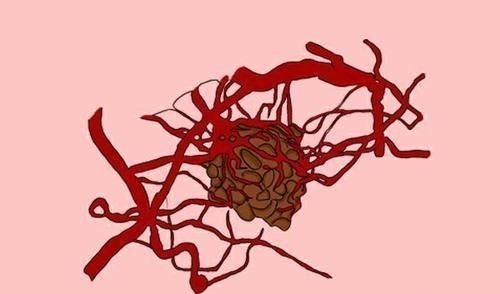 生活习惯|得了癌症,该怎么治疗?医生给出了具体建议,少走点弯路