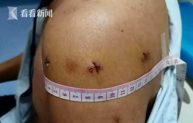 小叶|小心“习惯性脱臼”！18岁小伙6年脱臼10多次