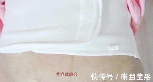 孕产妇|剖腹产是美容线好还是普通线好?区别有3点,产妇早知道早预防