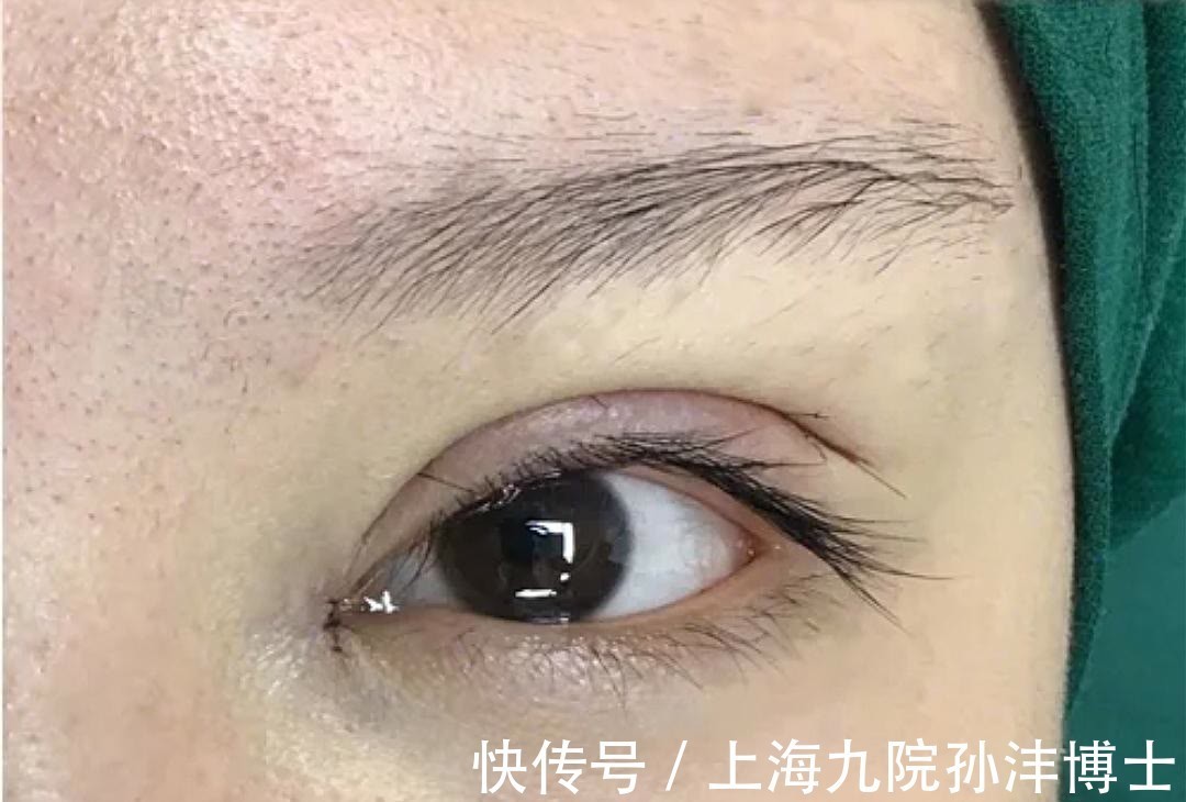 双眼皮 眼修复孙沣博士:双眼皮术后出现分叉能修复吗?