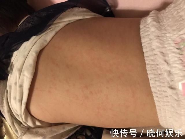 育儿百科|6个月后宝宝第一次发烧,多是幼儿急疹,烧退疹出,免疫力升级2.0