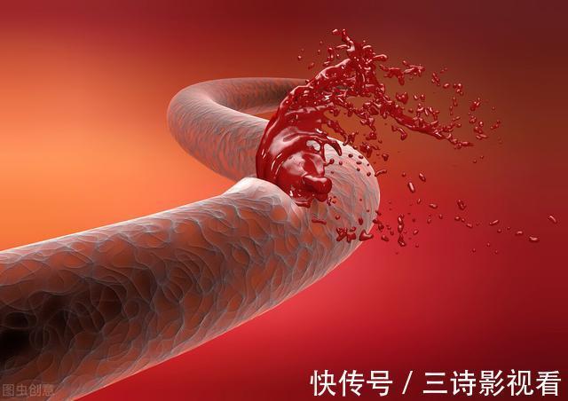 办法|家人突发脑出血咋办?医生教你家庭急救办法,家人有高血压的请看