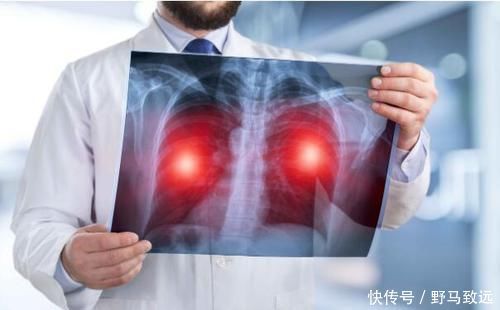 身体|身体出现这5种症状,或暗示你肺癌将至,趁早检查