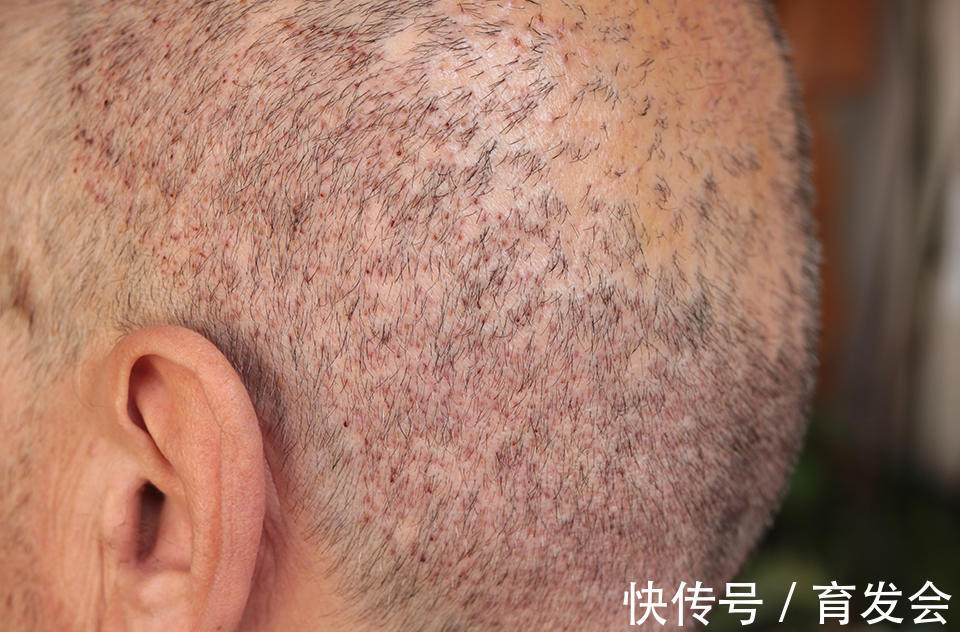 发际线 植发后头发还会脱吗?一般能维持多久?