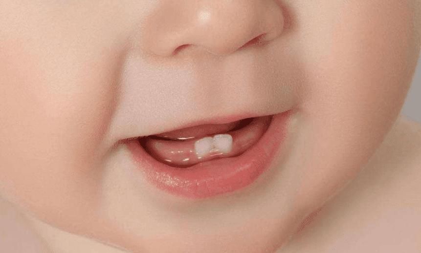 牙齿|95后宝妈不信乳牙能救命,结果后悔不已,新手爸妈要注意