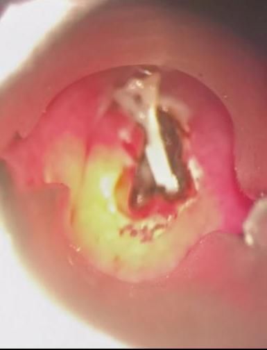 鱼刺卡喉|鱼刺卡喉用“老土方”？专家：不科学且危险！