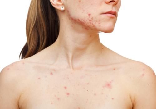 祛濕|濕氣重，肝火旺！9種食材煮水喝，祛濕降火，肚子平了，氣色好了