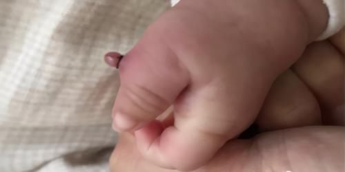孩子|女婴多长一根手指,老人用土办法“治疗”,孩子差点要截肢