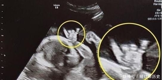 伊安娜|孕妇做B超被吓坏,孩子突然睁眼怪笑!医生却说……