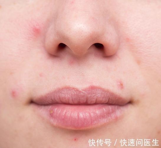 彩妆 脸上长了痘痘?不用着急,分享4招,帮助脸庞恢复白净