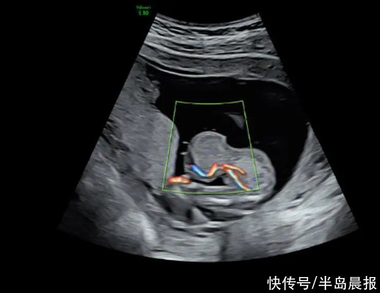 有惊无险！新生宝宝肝脏＂挂＂在肚子外，幸好……这病男宝宝多发