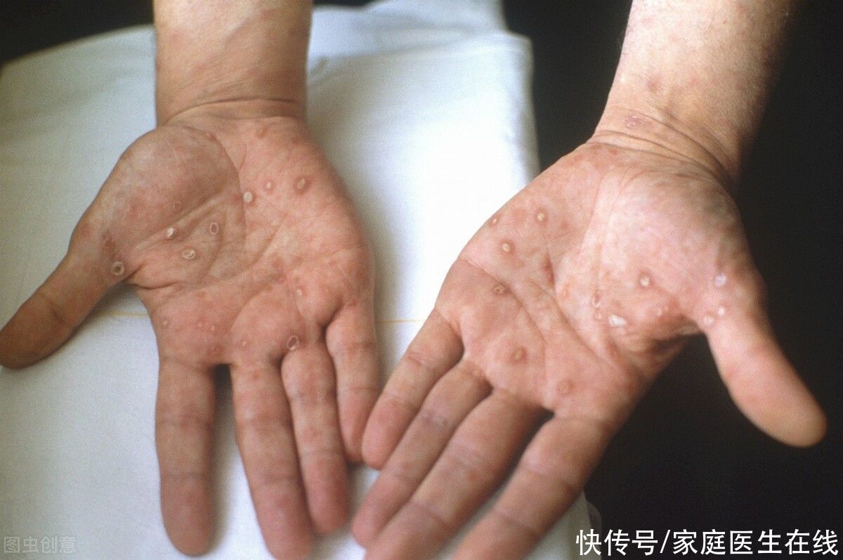 性行为|梅毒没症状却还会传染？这4个途径要警惕，别中招都不知道