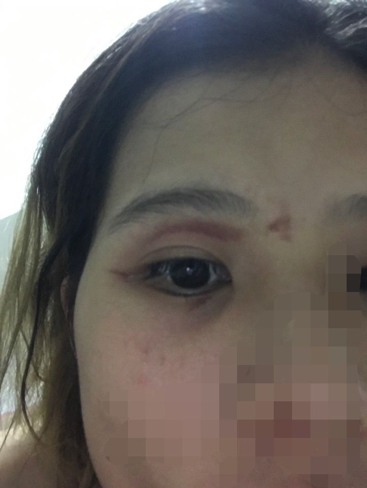 皮肤|6岁男孩只因惹了这个小家伙脸部皮肤溃烂。麻烦就在“举手之间”