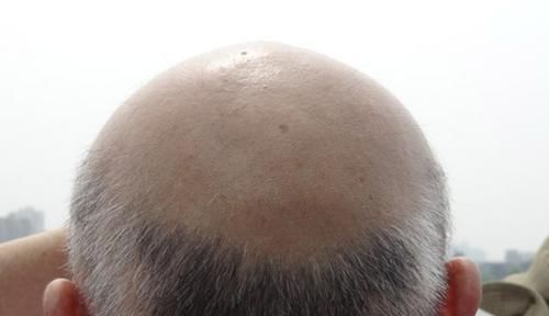 脱发|男人阳气不足，身体会露出“丑态”，被放跑的阳气，怎么补回来？