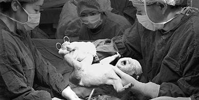 发明|西方发明的一种手术，早期死亡率高达85%，却给中国妇女带来福音