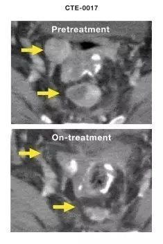 免疫疗法|重磅抗癌疫苗又获新突破，一名晚期癌症患者，5年无复发