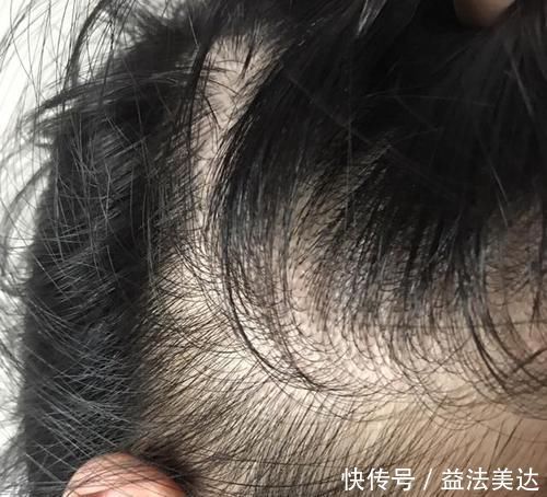 21岁女大学生脱发,惨遭谢顶,提醒:一种水少喝,不然早晚要光头