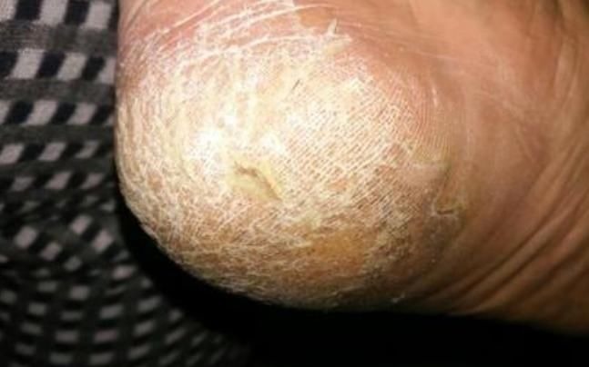 四不碰|双脚是肝脏健康的“报警器”,有4个症状,说明肝在变“坏”