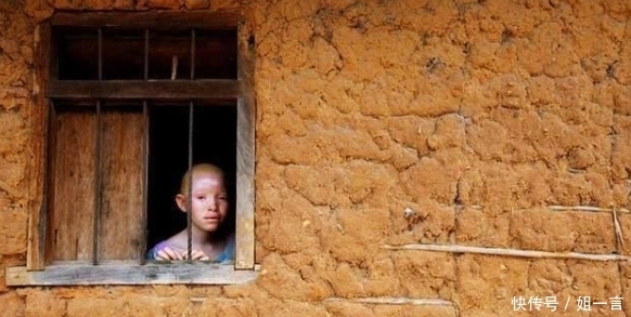 非洲“唐僧肉”,血液比黄金还贵,警察只能24小时守护他们