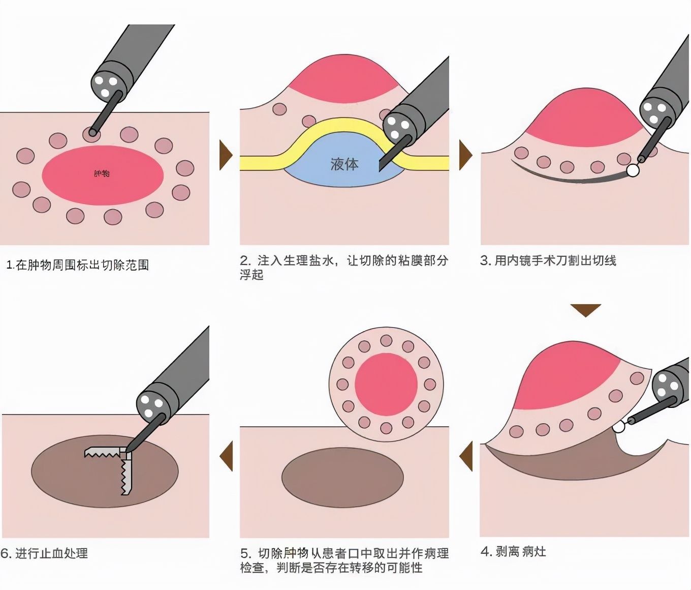 痊愈|胃病吃点药以为就痊愈了，医生从他胃部摘出个“菠萝包”，与这种菌密切相关