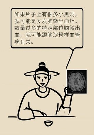瞌睡|记性变差容易瞌睡，有可能是这种脑出血