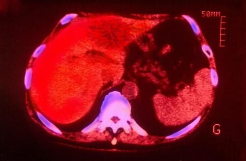 黄曲霉毒素|肝癌的高危人群有哪些?肝功能异常,或有9个征兆,别当成小问题