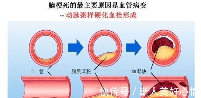 冠状动脉|动脉粥样硬化——随时可能引爆的定时炸弹