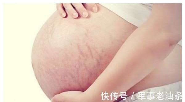 妊娠纹|孕期出现这三种情况,就是长妊娠纹的“征兆”,孕妈要提早预防
