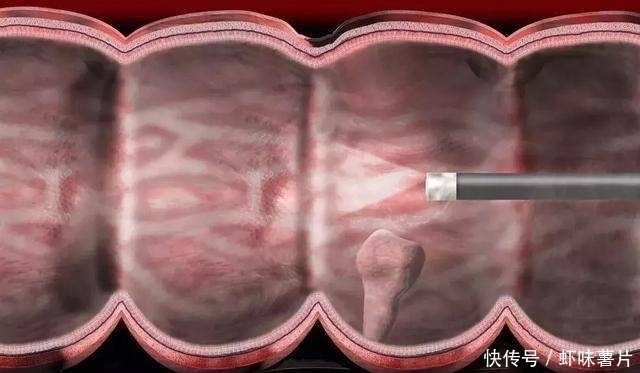 息肉|两种息肉一定要及时切除，一拖再拖会变成恶性肿瘤