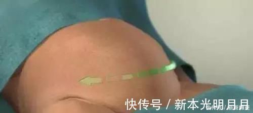 自然分娩|剖腹产到底是怎么“剖”的一组图看清全过程,每个妈妈都是超人