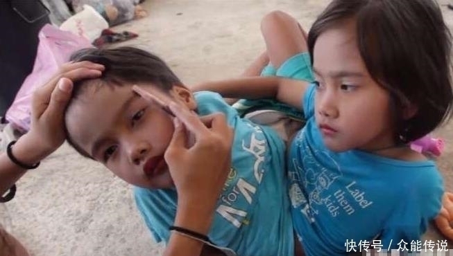 共享|7岁男女连体人被父母抛弃,兄妹共享一双腿,洗澡上厕所显为尴尬