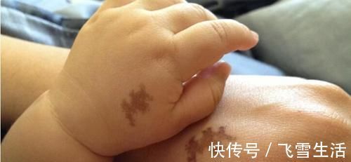 胎儿|胎记是怎么来的产科医生孕期远离3种行为,避免胎儿长记号