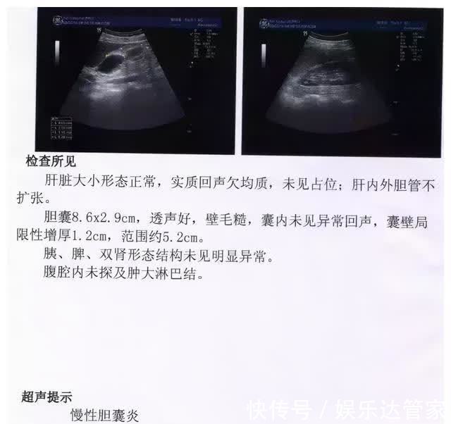 胆囊息肉|胆囊息肉你知多少?这时候了解,还不算晚