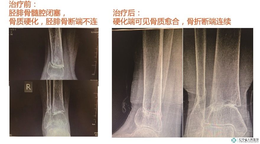 康复|富血小板血浆+冲击波 治疗骨折后骨不连