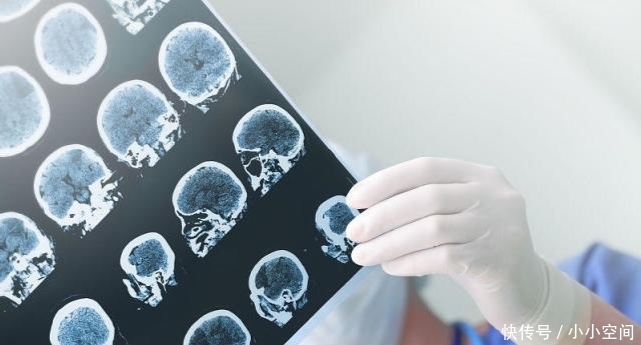 55岁男子不碰肥肉，脑梗离世，医生直言：厨房一种白色调料是祸根