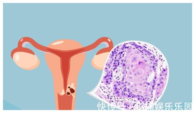 免疫|46岁女子腿疼入院，3个月后宫颈癌变离世，医生惋惜：拖的时间