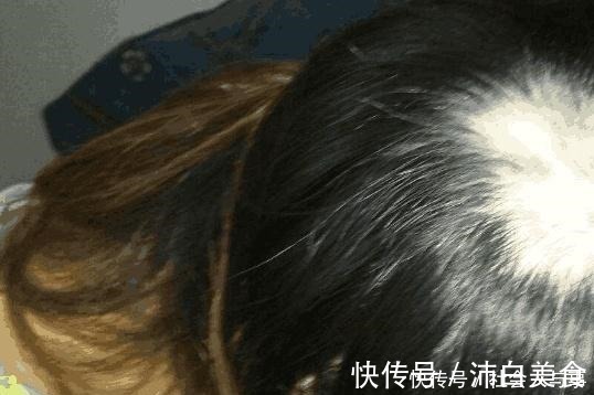 妈妈|医生提醒妈妈们给孩子扎辫子时不可用力过猛,会患上脱发类疾病!