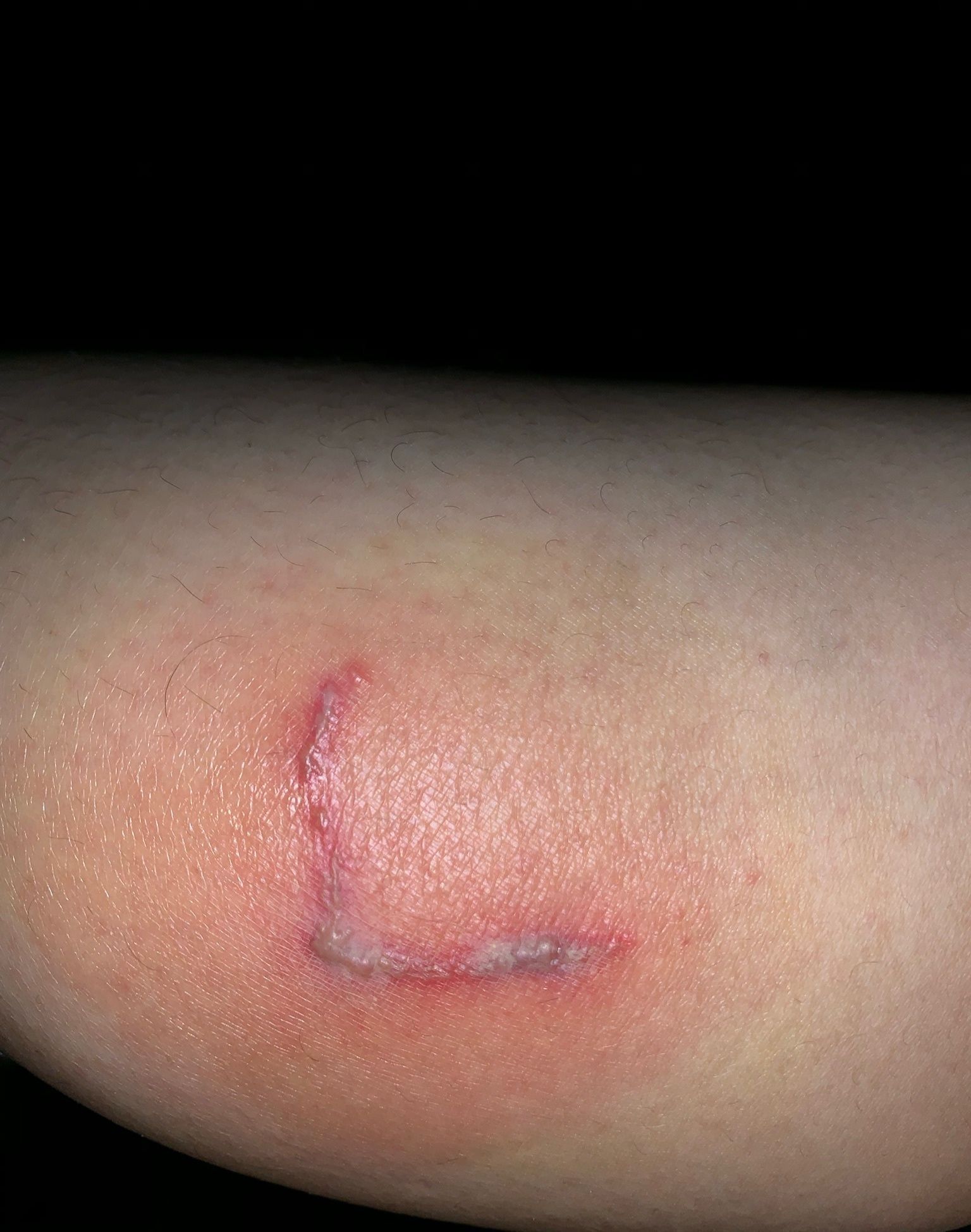 隐翅虫|6岁男孩只因惹了这个小家伙脸部皮肤溃烂麻烦就在“举手之间”