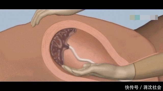 妈妈们|为什么有些产妇生完孩子后,胎盘不能自动娩出,还需要手剥胎盘