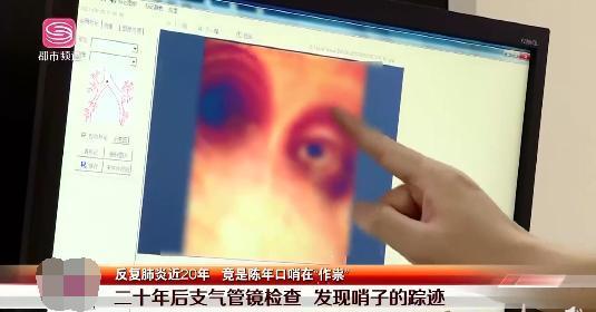 海姆立克法|男子6岁时吞了个……怕被家长骂,竟瞒了20年