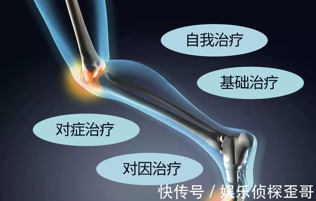 关节炎|晚期关节炎能靠人工关节置换术夺回健康？医生讲明不早用的理由