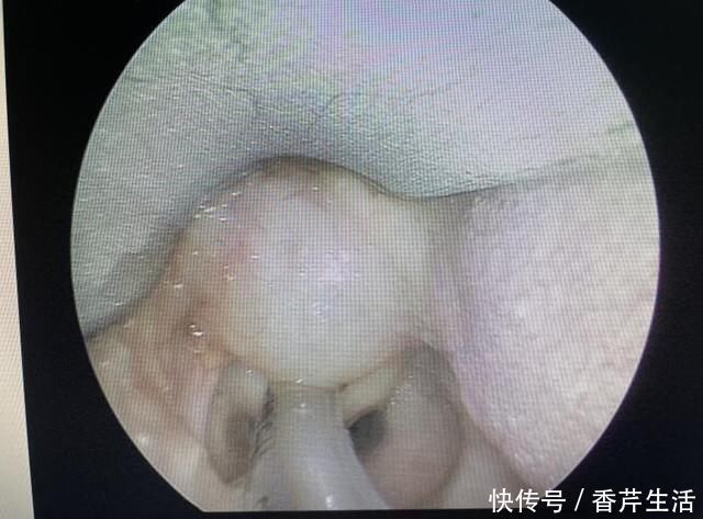 气管|真·如鲠在喉!济一2个月小孩嗓子里长了巨大肿瘤