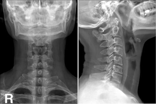 椎体|脊柱常见肿瘤及肿瘤样病变的几种影像学表现，你都见过吗？