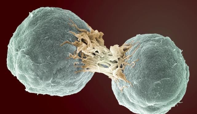 肺癌|肺癌治疗已进入精准治疗时代,治疗新方法可能将肺癌变为慢性病