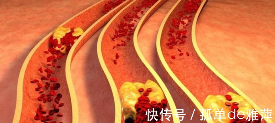 胆固醇|低密度脂蛋白升高有什么症状少碰4种食物，帮助血脂慢慢稳定