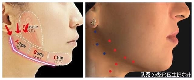 怎么提升侧颜的高级感？医生来支招：找回消失的下颌线