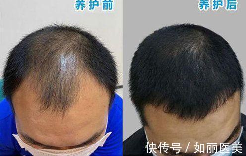 技术 植发技术好不好?植发和微针植发哪个好?优缺点分析