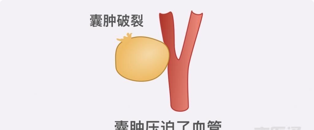 卵巢囊肿|结节、息肉、囊肿是癌症先兆吗？北肿专家们说出了真相！