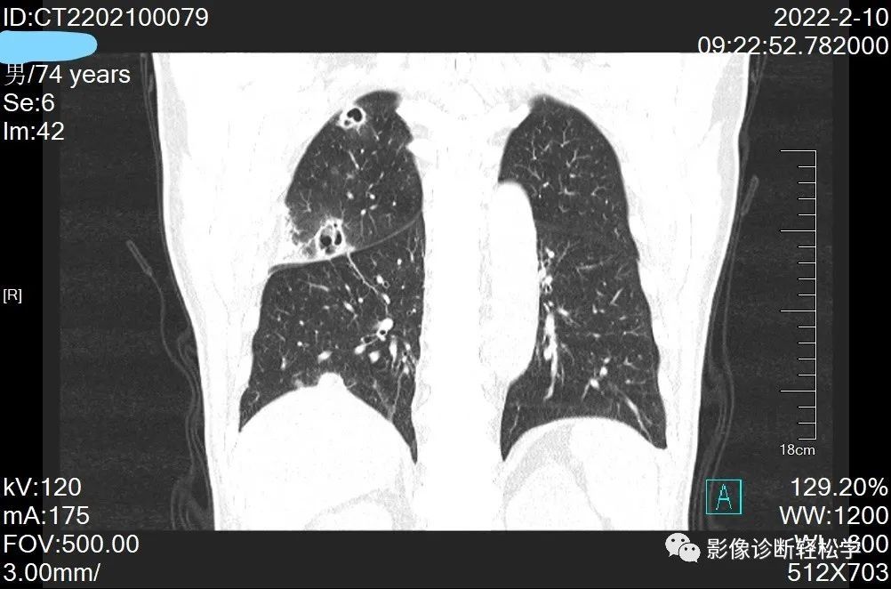 金葡菌|快快乐乐过大年，轻松学习肺部影像 实战篇 续